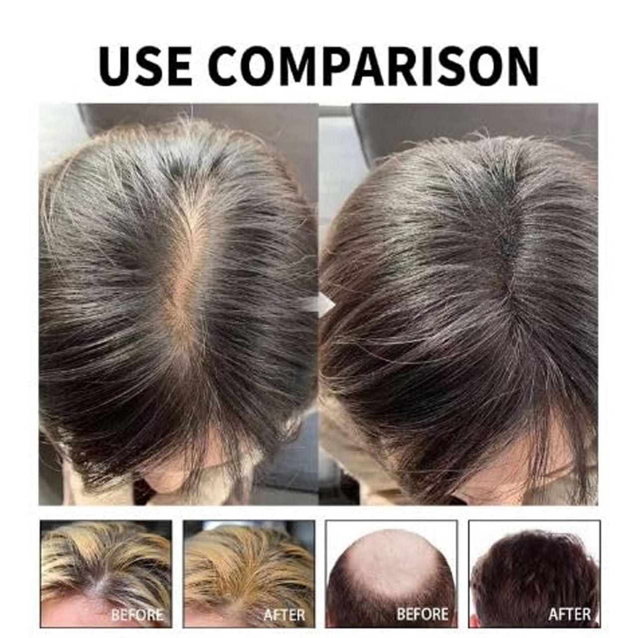 Hair Loss Treatment Serum 30Ml (Pack Of 2) new1wu-ts