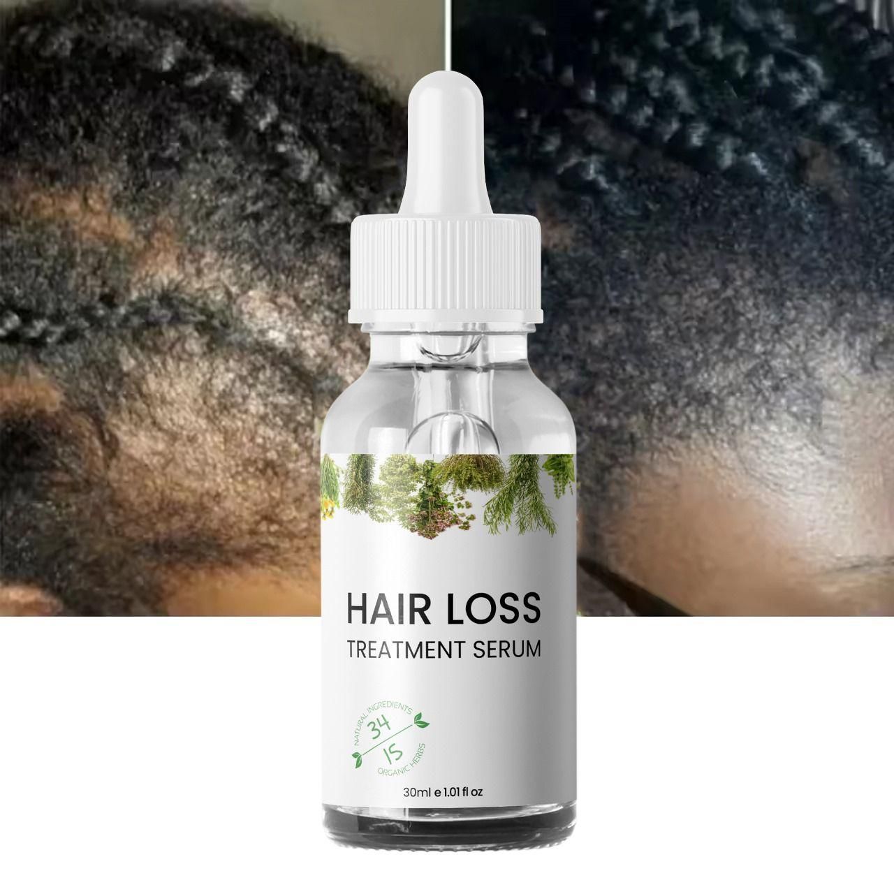 Hair Loss Treatment Serum 30Ml (Pack Of 2) new1wu-ts