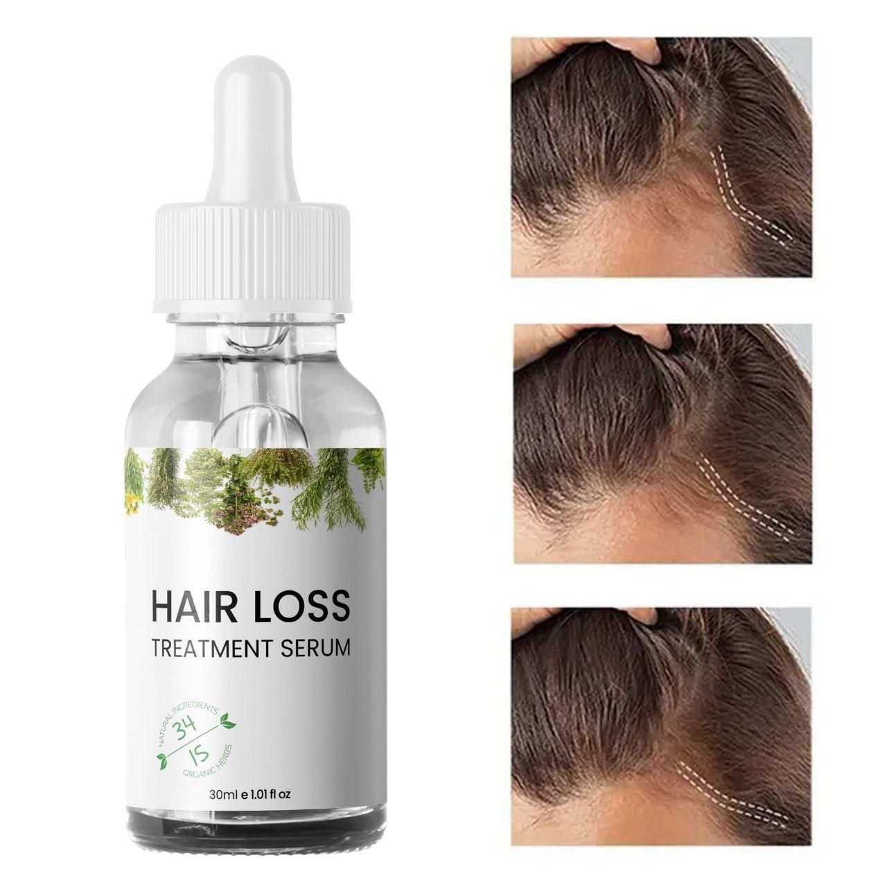 Hair Loss Treatment Serum 30Ml (Pack Of 2) new1wu-ts